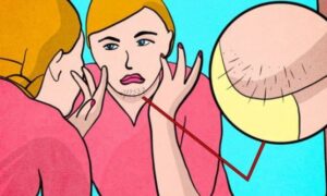 Признаки проблем со здоровьем у женщин: на что указывает рост волос на лице