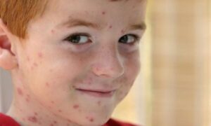 Ветрянка: как распознать первые симптомы и защитить себя
