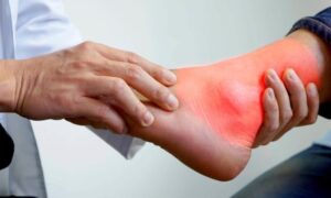 Как снизить мочевую кислоту и избежать подагры: советы врача