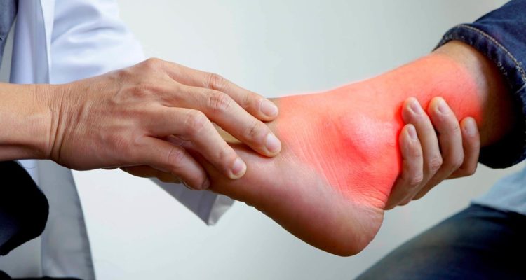 Как снизить мочевую кислоту и избежать подагры: советы врача