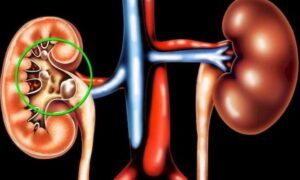 Камни в почках: 5 советов для здоровья и профилактики