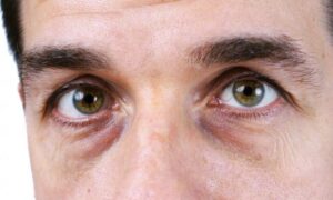 Натуральные средства от темных кругов под глазами: секреты молодой мамы