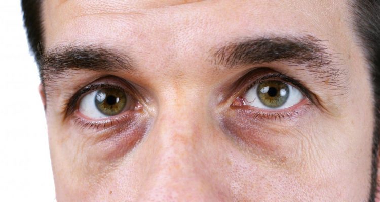 Натуральные средства от темных кругов под глазами: секреты молодой мамы