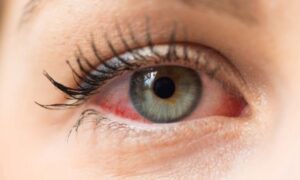 Почему краснеют глаза: 5 главных причин, о которых стоит знать каждой женщине